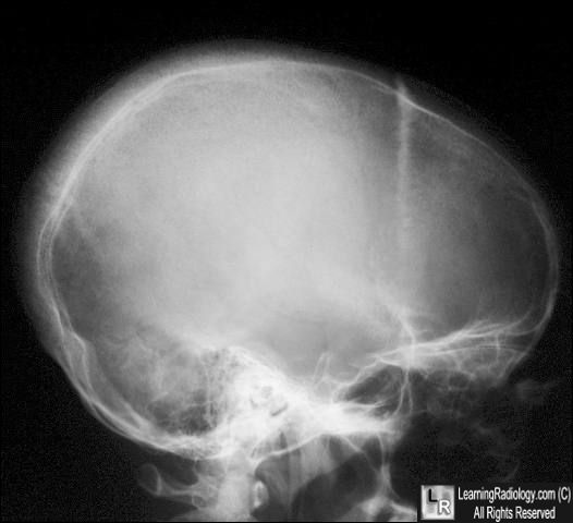 Sickle cell-skull